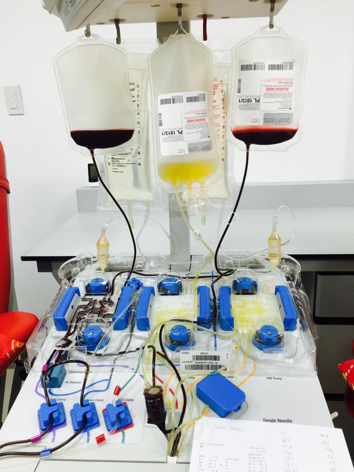 Benefits of plasma exchange therapy for immune support and improved overall health